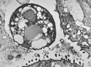 M,33y. | cryptosporidiosis - duodenum, im | munodeficient pacient